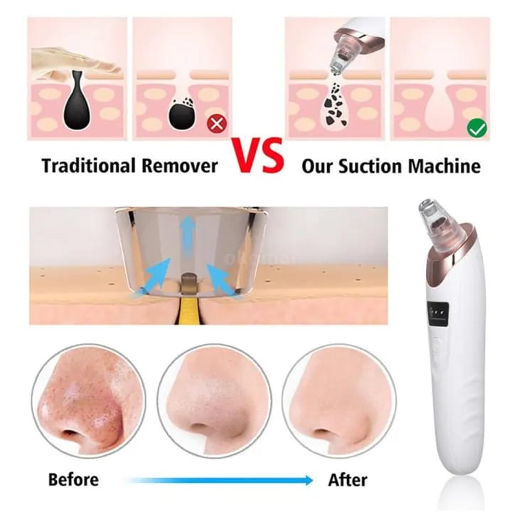 5-in-1 Electric Blackhead Remover Vacuum – Deep Pore Cleaner for Face & Nose (Rechargeable Skin Care Tool)